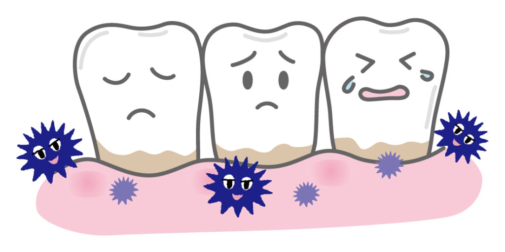 大和市鶴間の歯医者スギヤマ歯科医院　歯石はどのくらいの頻度でキレイにするのがいい？