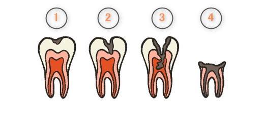 大和市鶴間の歯医者スギヤマ歯科医院　痛みが急に治まったら要注意！虫歯の痛みと歯の神経