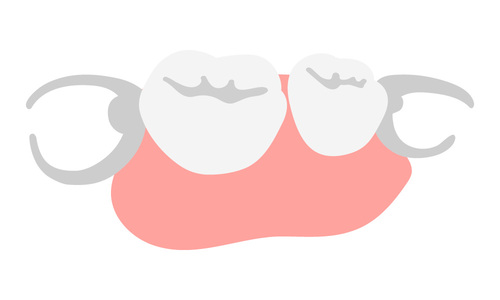 大和市鶴間のスギヤマ歯科医院　保険適用の部分入れ歯、目立たないように01