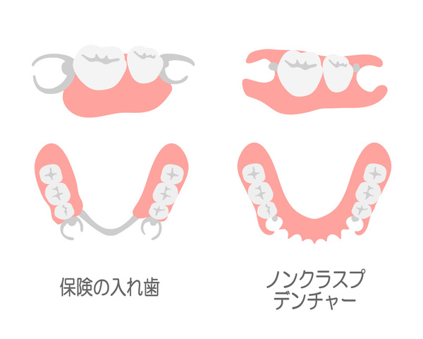 大和市鶴間のスギヤマ歯科医院　保険適用の部分入れ歯、目立たないように02