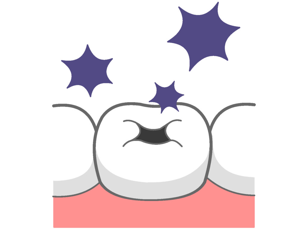 大和市鶴間スギヤマ歯科医院 銀歯が取れたときの治療費と取れたときの注意点04