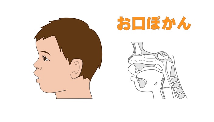 お口ぽかん